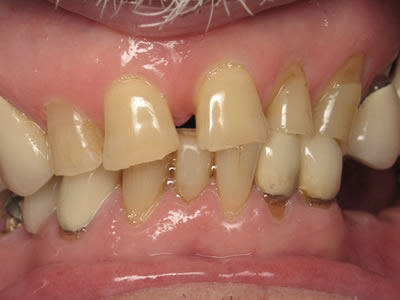 Odontología estética y reconstructiva Dentista Torreon coahuila Gomez palacio durango