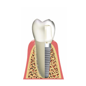 Odontología estética y reconstructiva Dentista Torreon coahuila Gomez palacio durango