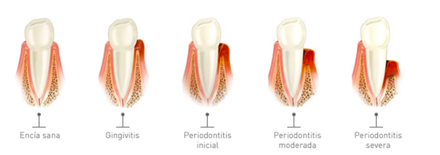 Periodoncia Dentista Torreon coahuila Gomez palacio durango