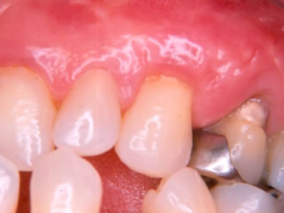 Periodoncia  Dentista Torreon coahuila Gomez palacio durango