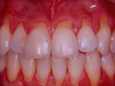 Periodoncia  Dentista Torreon coahuila Gomez palacio durango