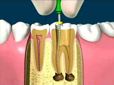 Endodoncia  Dentista Torreon coahuila Gomez palacio durango