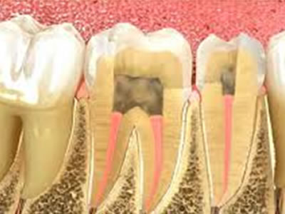 Endodoncia  Dentista Torreon coahuila Gomez palacio durango